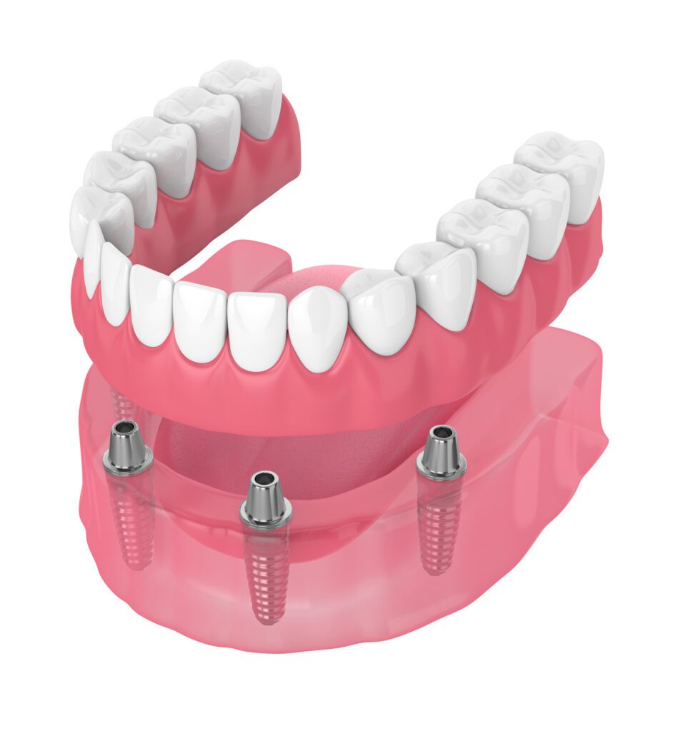 Our skilled team recognizes the transformative impact that dental implants can have on both oral health and overall well-being.