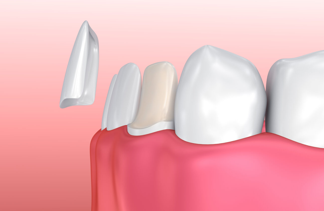 Porcelain veneers and dental bonding are popular cosmetic dental treatments, but they aren't always interchangeable.